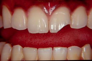 наращивание передних зубов